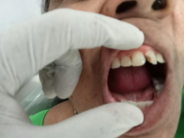 Teeth Repair