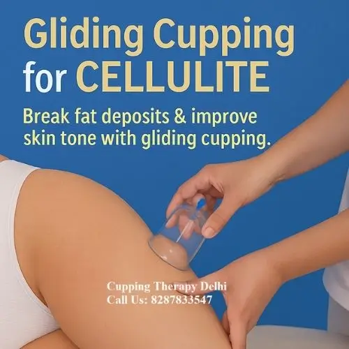 cupping cellulite reduction