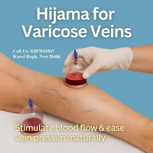 hijama varicose veins