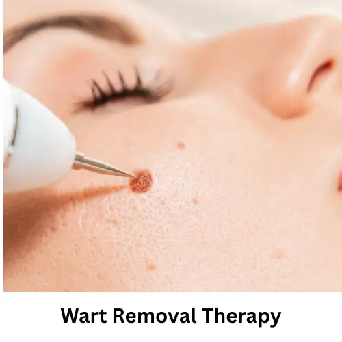 Wart Removal Therapy